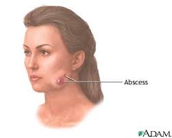 http://www.nlm.nih.gov/medlineplus/ency/images/ency/fullsize/17245.jpg