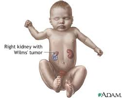 Wilms  tumor 