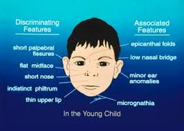 Fetal alcohol syndrome FAS is a