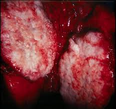  Lung Cancer 