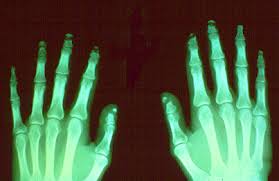 http://www.cdc.gov/niosh/topics/skin/images/derm087.gif