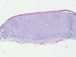 http://www.dermpedia.org/files/images/Clear_cell_acanthoma__2.jpg