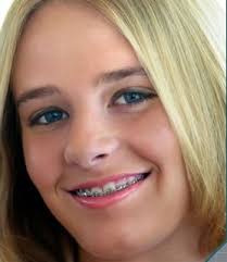 Removing Braces