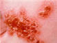 The Sixth Plague: Boils -- מכות מצרים: מכת שחין