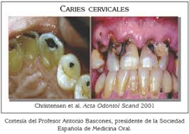 http://scielo.isciii.es/img/revistas/odonto/v23n3/119fig4.jpg