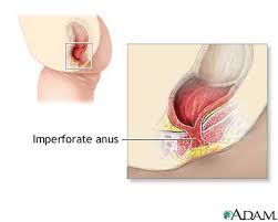 Imperforate Anus Repair