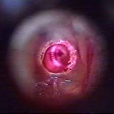 Myringotomy and insertion of 