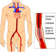  angioplasty  diagram