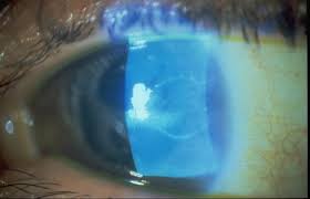 http://www.bausch.com/en_US/ecp/resources/image_library/full_img/photo224.jpg