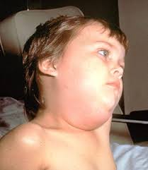 Boy with Mumps