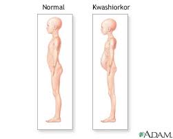 Kwashiorkor