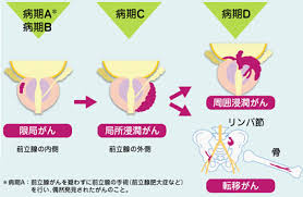 前立腺がんの進行と生存率