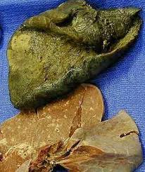 http://www.robertsreview.com/images/cancer_px/lung_cancer_adenocarcinoma_tumor.jpg