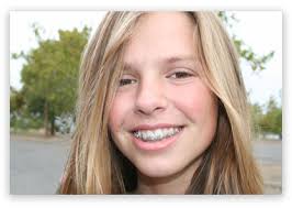 While getting braces