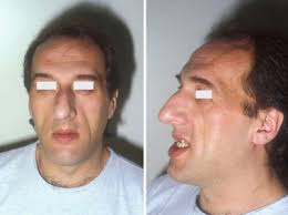 http://upload.wikimedia.org/wikipedia/commons/1/1a/Acromegaly_prognathism.JPEG