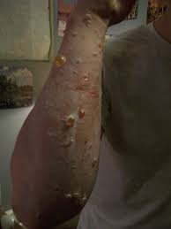 Severe Poison-ivy Infections