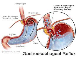 What is GERD  acid reflux   
