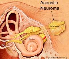 ACOUSTICNEURIN, ACOUSTICNEURIN