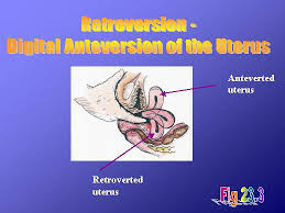 What is a  retroverted uterus ?