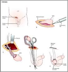  Undescended testicles 