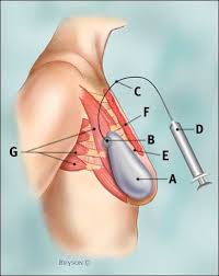 Filled Tissue Expander