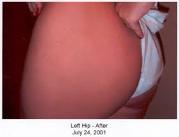      wonderful  stretch mark cream   