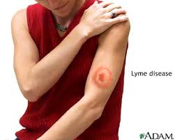  Lyme disease 