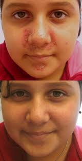  Acrodermatitis  enteropathica