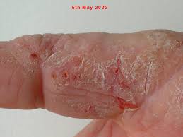 (hand photo, skin reaction)