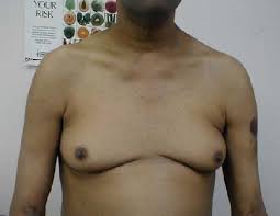 http://www.living-with-large-breasts.com/images/gynecomastia.jpg