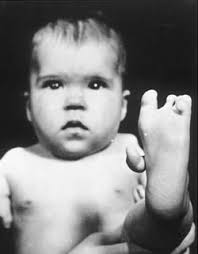 the drug thalidomide. - via Daymix
