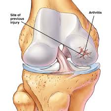 Rheumatoid  Arthritis 