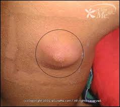 http://www.ecureme.com/atlas/data/dis_images/skin_abscess550_ab.jpg