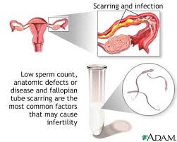 Causes of  infertility  include