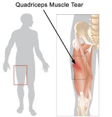 Groin  Strain  (Adductor