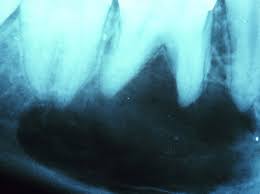 http://www.library.vcu.edu/pdfgif/tml/oralpathology/44-traumatic-bone-cyst.jpg