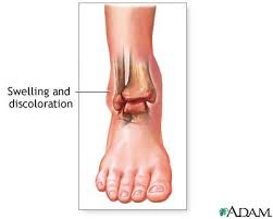 The  ankle  is the most commonly