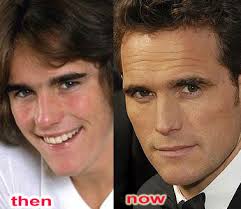 Image <b>Matt Dillon's</b> Rhinoplasty Picture