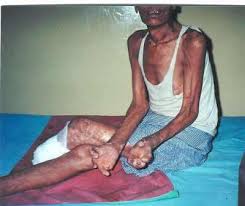 Leprosy Victim - via Daymix