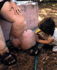Vicki has Lymphedema in here