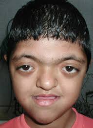 apert syndrome