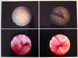 Images from a  cystoscopy .