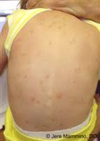 http://www.aocd.org/images_ddd/Mastocytosis_1_low.jpg