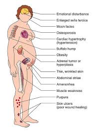  Cushing syndrome :