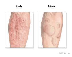  Allergic Reactions 