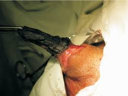 Penile  Cancer : Inspiring &amp;