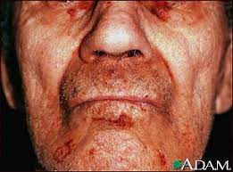 http://www.nlm.nih.gov/medlineplus/ency/images/ency/fullsize/2366.jpg