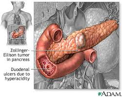 hormone  gastrin ,
