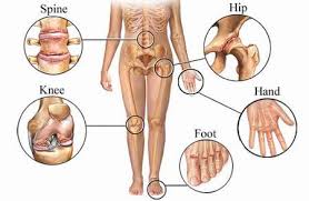 of  arthritis 