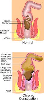 Cleanse Cures  Constipation 